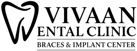 Invisalign aligners