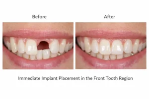 "immediate dental implant before and after results"
