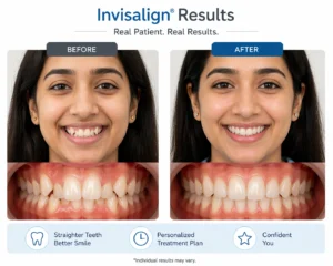 Before and after of an Invisalign patient — crowded teeth to aligned smile