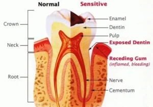 "tooth sensitivity diagram – how exposed dentine causes pain" 