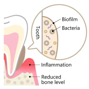 "oil pulling and bacteria reduction – what research says" 