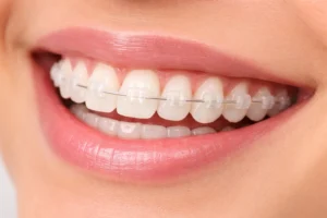  "ceramic braces in India – cost and appearance" 
