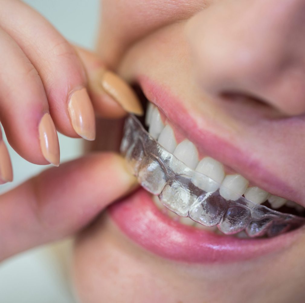 Close-up of woman wearing orthodontic silicone invisible braces Close-up of woman wearing orthodontic silicone invisible braces